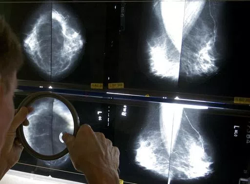 A radiologist uses a magnifying glass to check mammograms for breast cancer in Los Angeles, May 6, 2010. An influential U.S. task force now says women should get screened for breast cancer every other year starting at age 40. The U.S. Preventive Services Task Force announced the updated guidance Tuesday, April 30, 2024. (AP Photo/Damian Dovarganes, File)