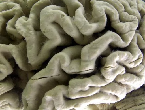 This Oct. 7, 2003 file photo shows a closeup of a human brain affected by Alzheimer's disease, on display at the Museum of Neuroanatomy at the University at Buffalo in Buffalo, N.Y. An experimental Alzheimer’s drug modestly slowed the brain disease’s inevitable worsening, researchers reported Tuesday, Nov. 29, 2022 - and the next question is how much difference that might make in people’s lives. Japanese drugmaker Eisai and its U.S. partner Biogen had announced earlier this fall that the d